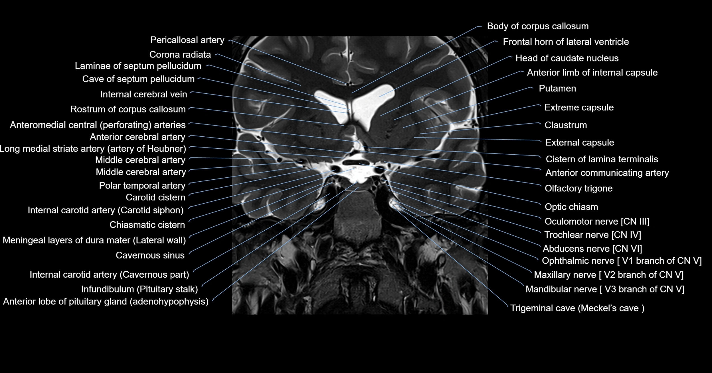 MRI brainstem & basal ganglia anatomy labelled 3T MRI images -img-00001-00011.webp